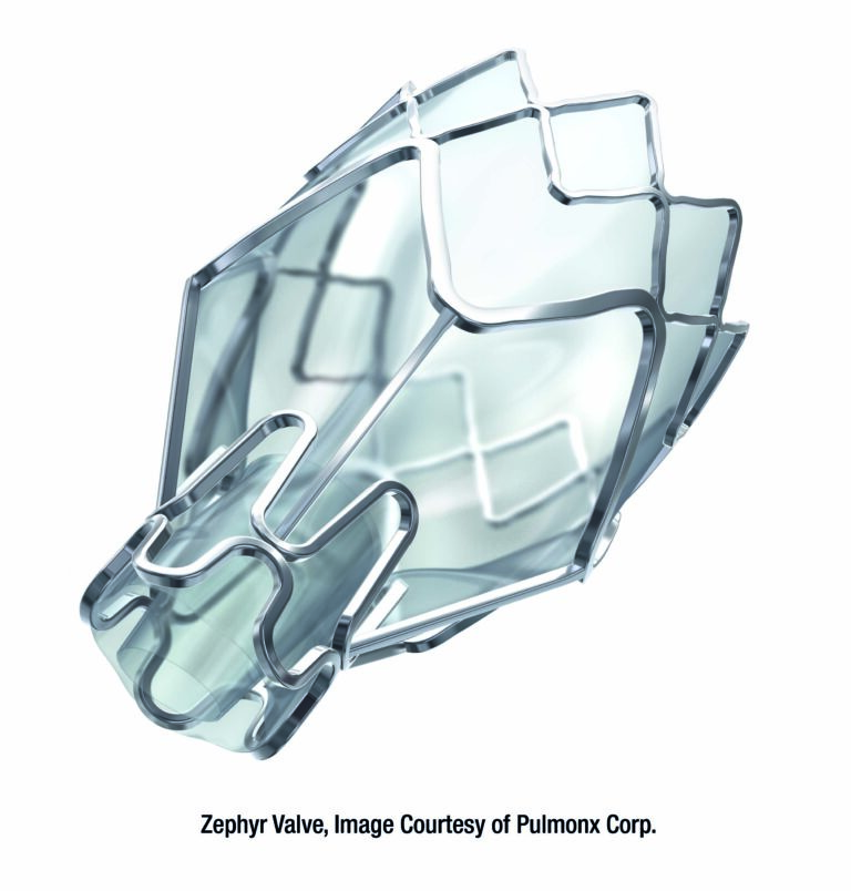 Zephyr Endobronchial Valve Procedure For Severe Copd Emphysema Thomas