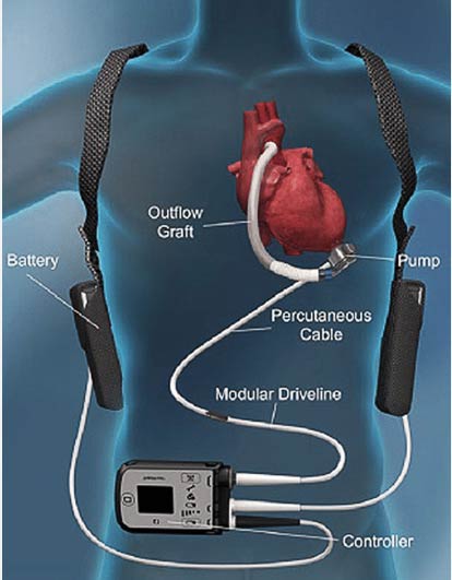 Left Ventricular Assist Device (LVAD)