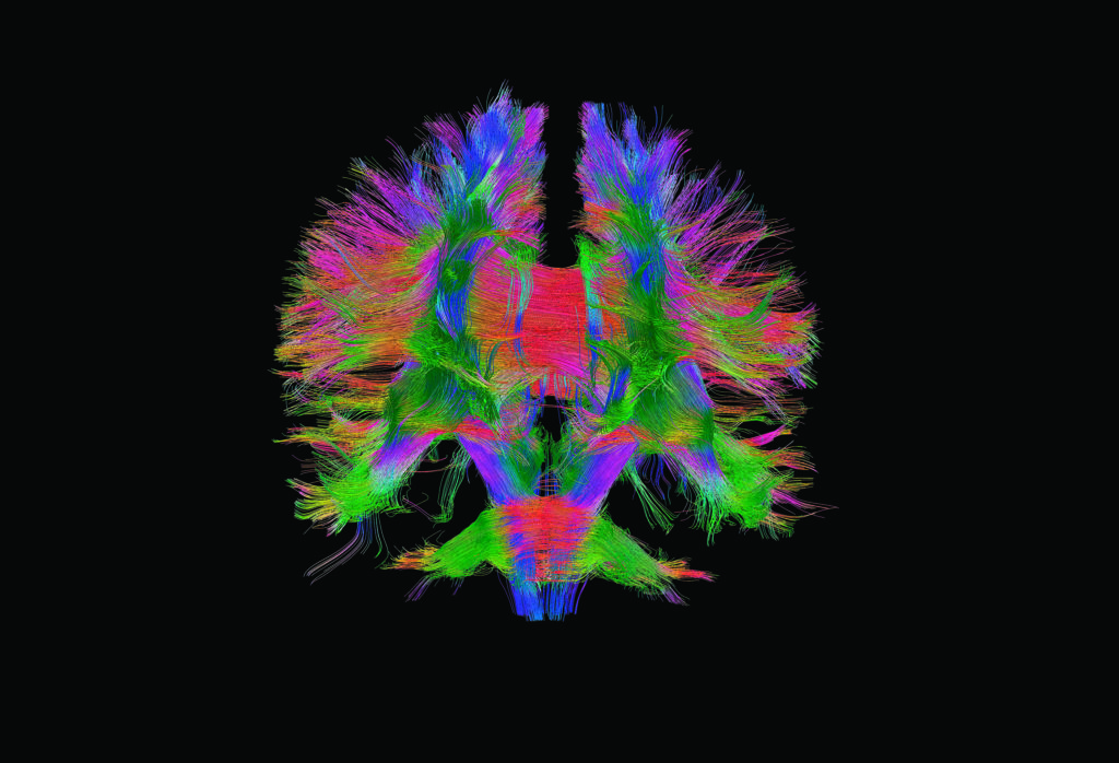 Brain fibres front view, DTI scan
